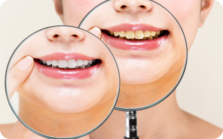 着色汚れの除去