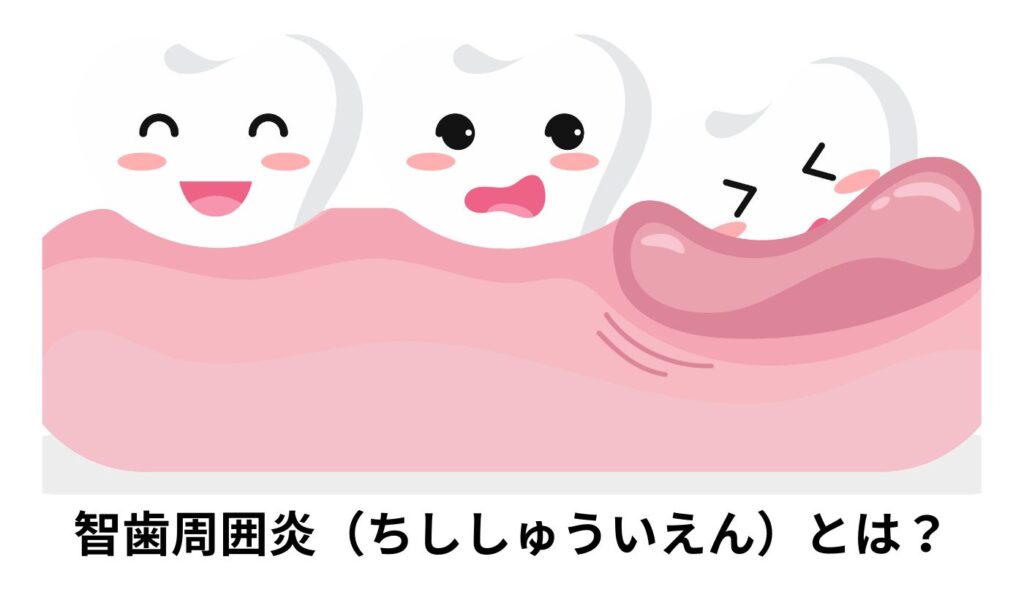 智歯周囲炎とは