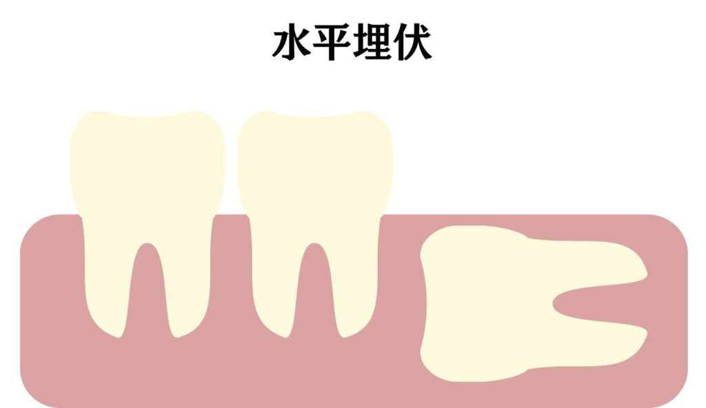 親知らず　抜歯　上と下どっちが痛い　水平埋伏